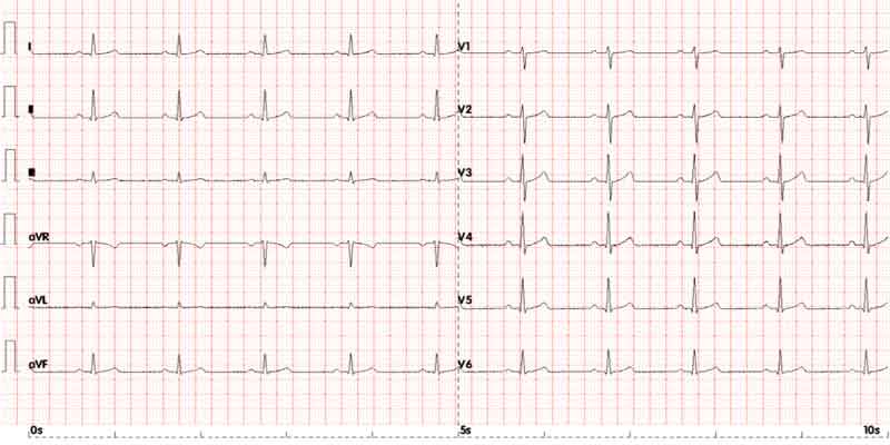 ECG