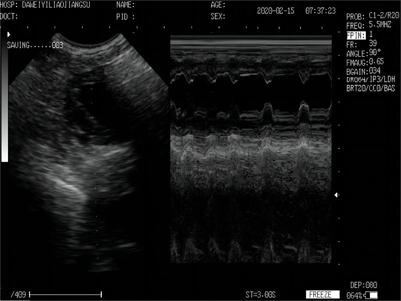 Images de BM cardiaque