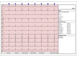 Électrocardiogrammes multiparamètres à 12 canaux