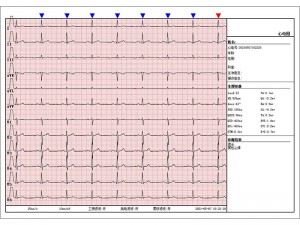 Eletrocardiogramas multiparâmetros de 12 canais