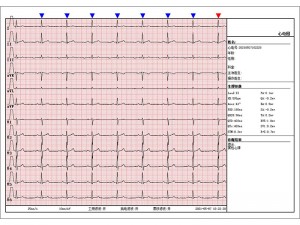 Électrocardiogrammes multiparamètres à 12 canaux