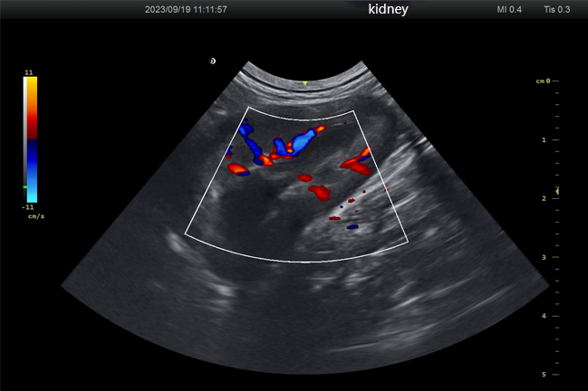 Blood-flow-effect-of-microconvex-kidney