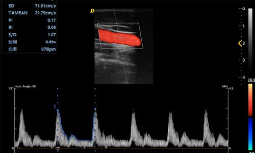 Carotid-spectrum-autography