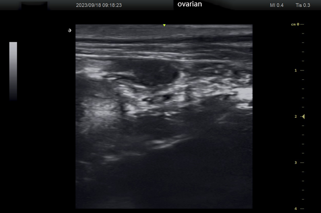 Linear-array-left-ovarian-effect