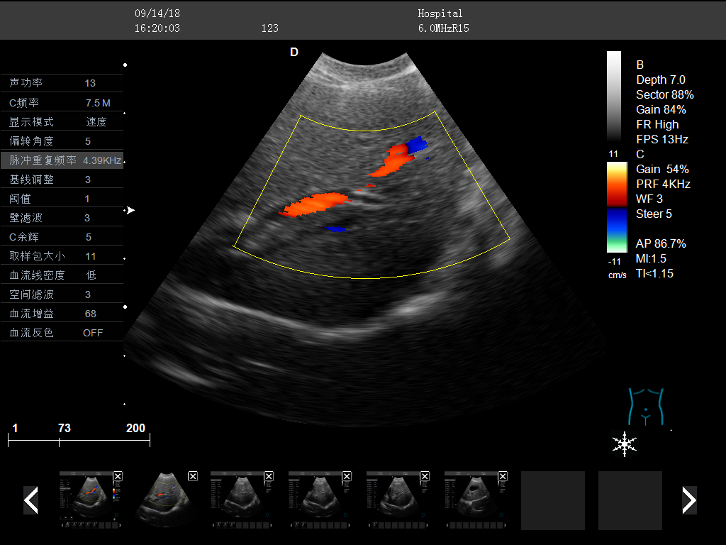 Liver color doppler