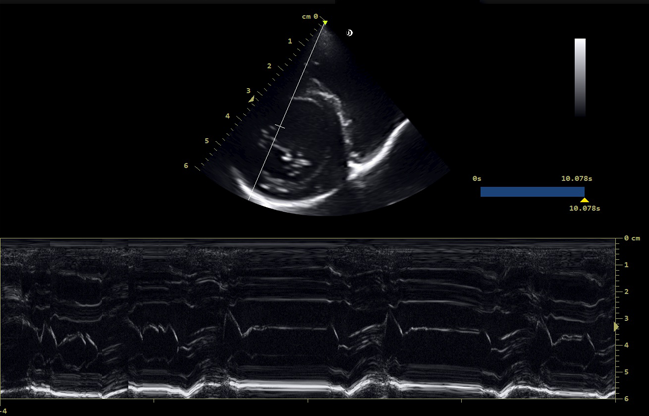 Mitral-valve-short-axis-M-shaped-effect