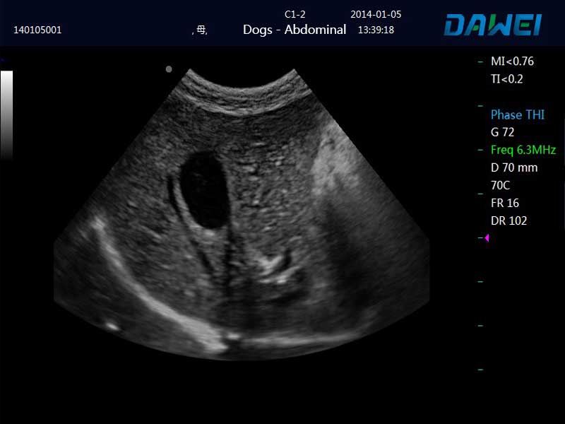 Slightly-convex-liver-and-gallbladder-effect